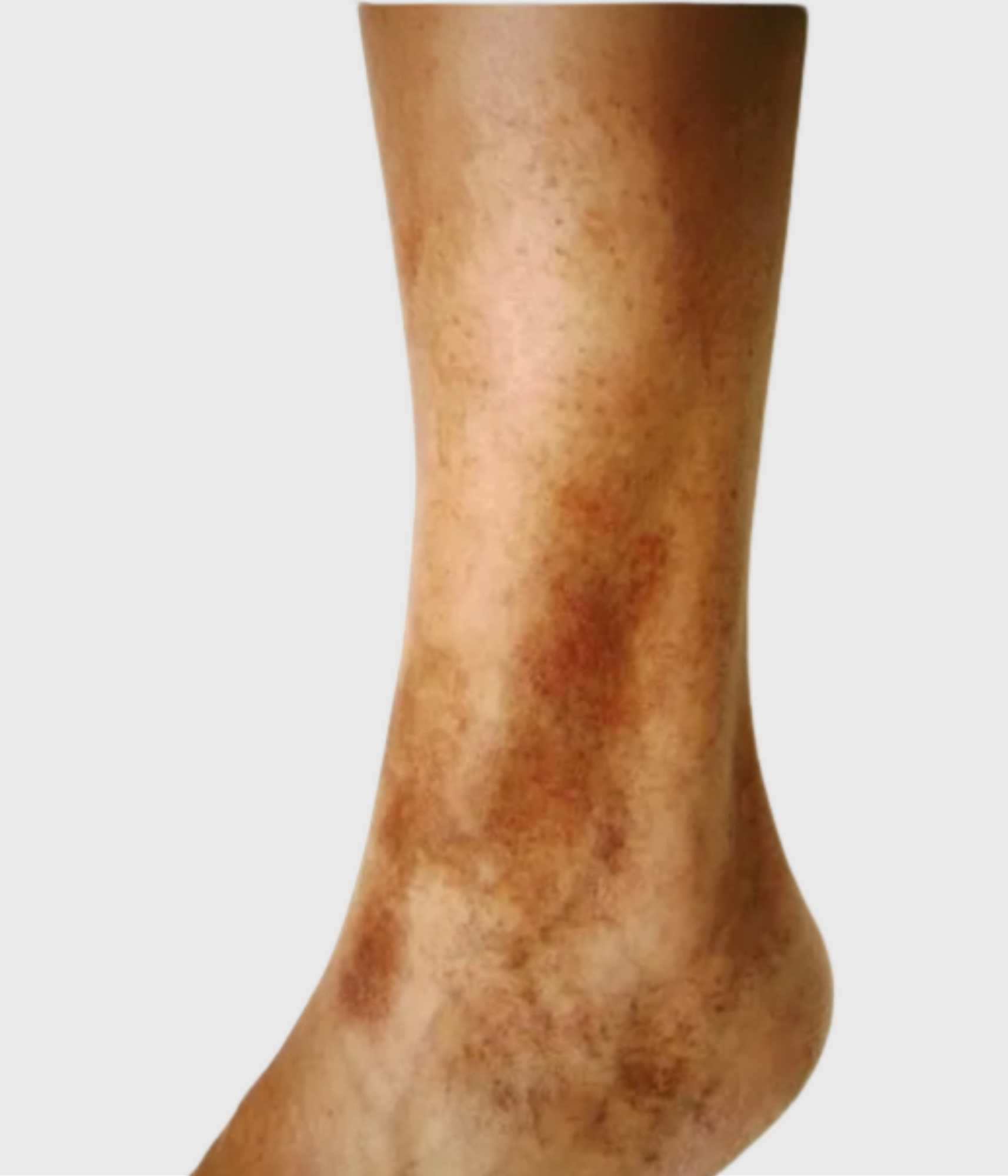 Pigmented Purpuric Dermatosis (PPD)