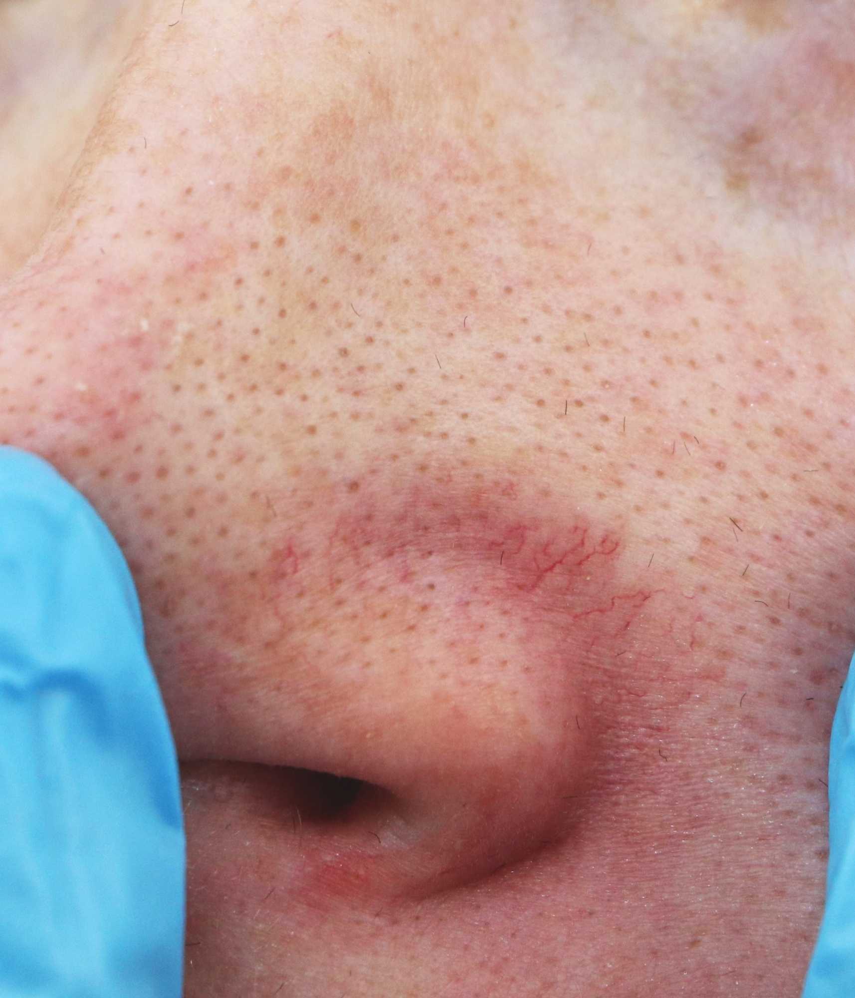 Other facial vein conditions