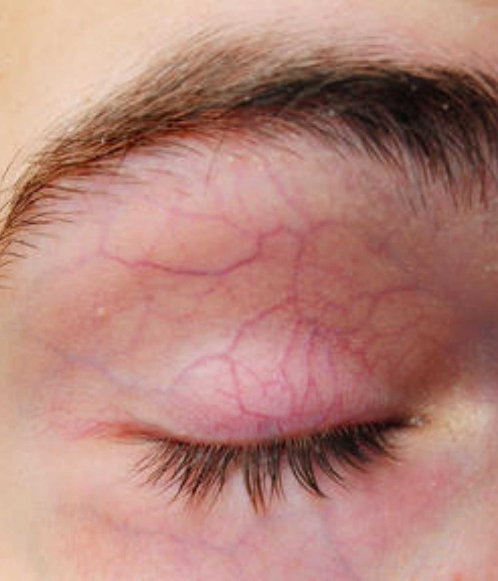 Veins around the eyes