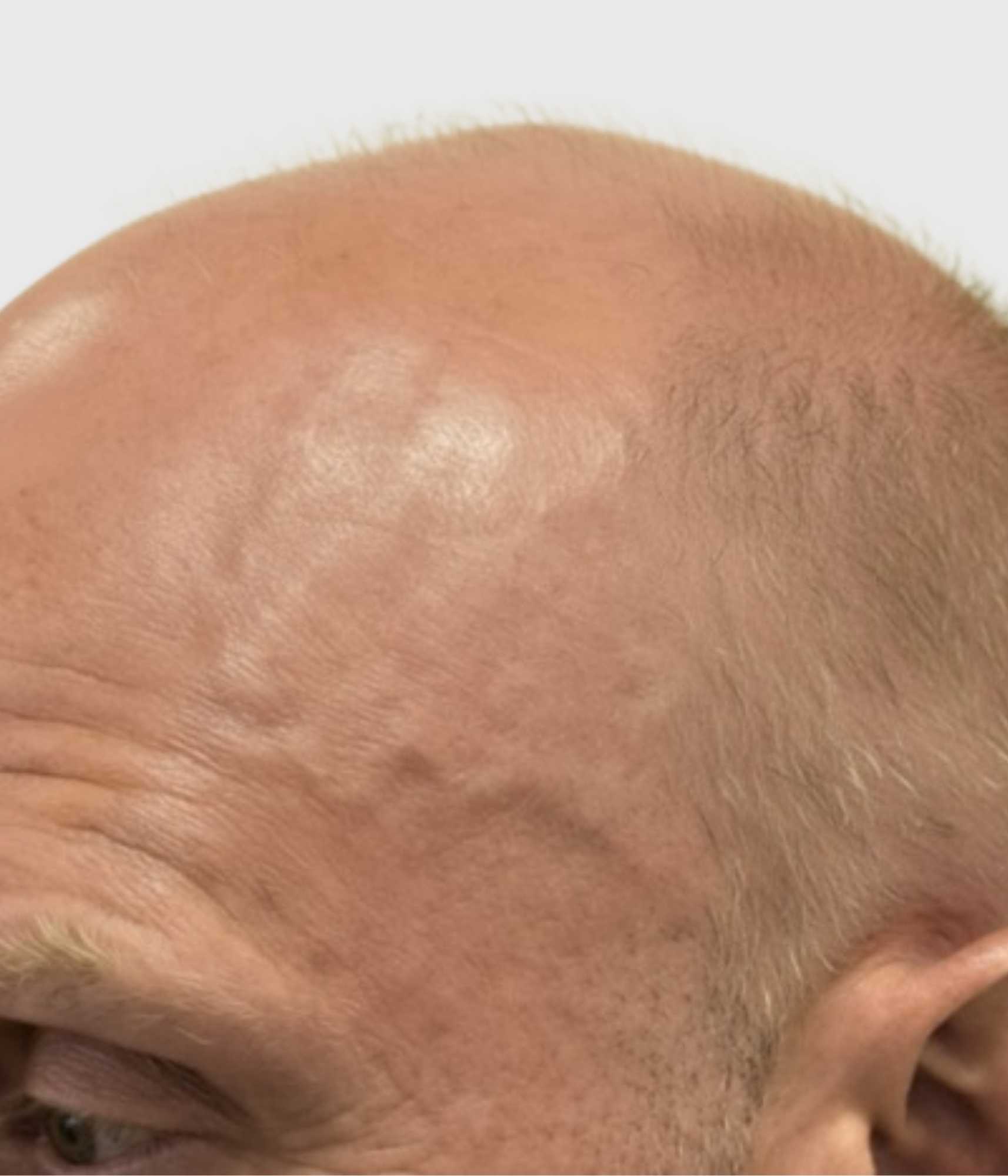 Temporal Veins (Temple Veins)