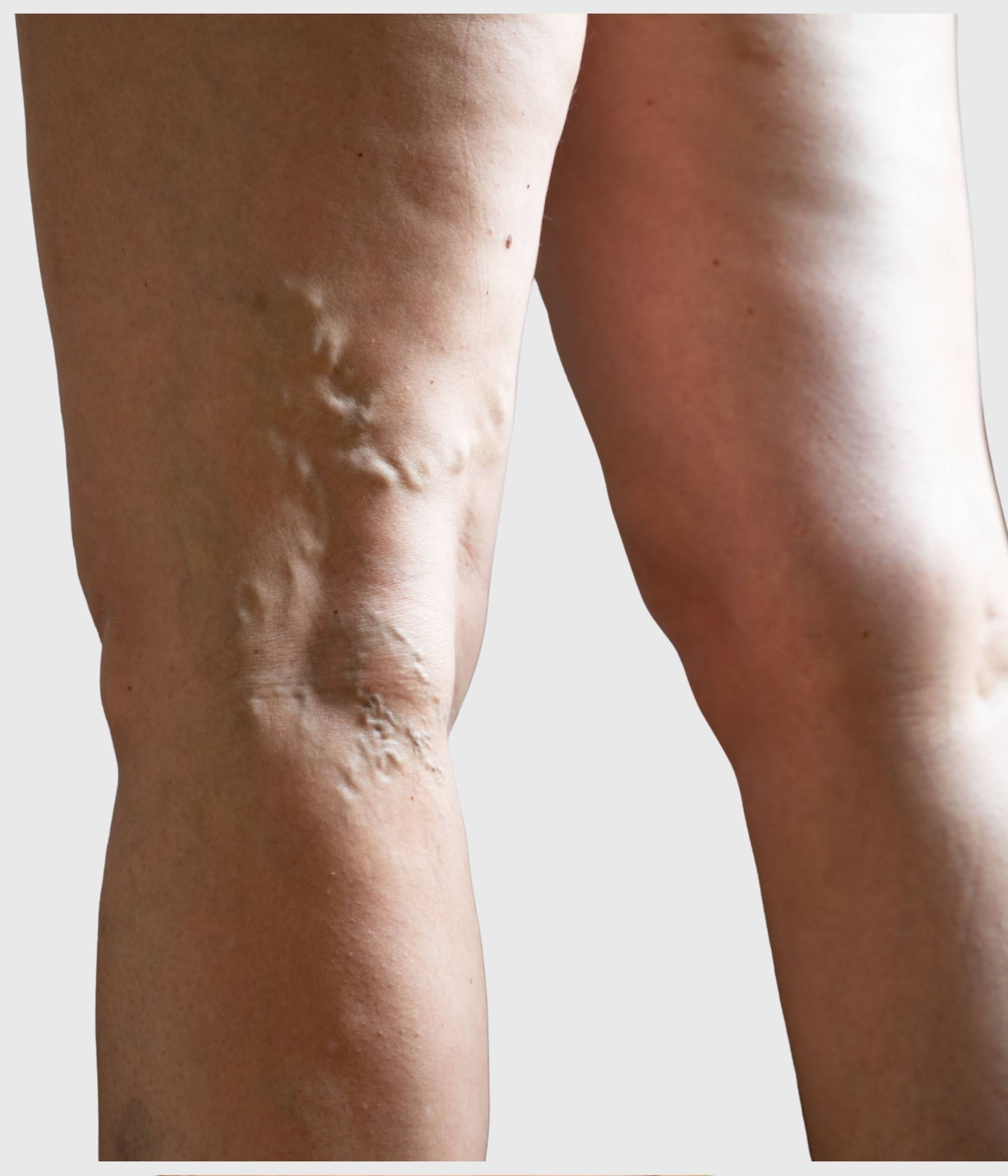 Recurrent Varicose Veins