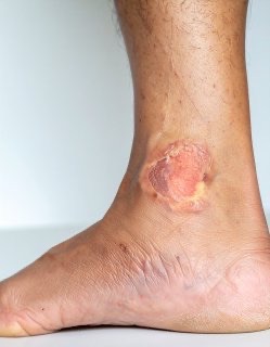 Leg Ulcers