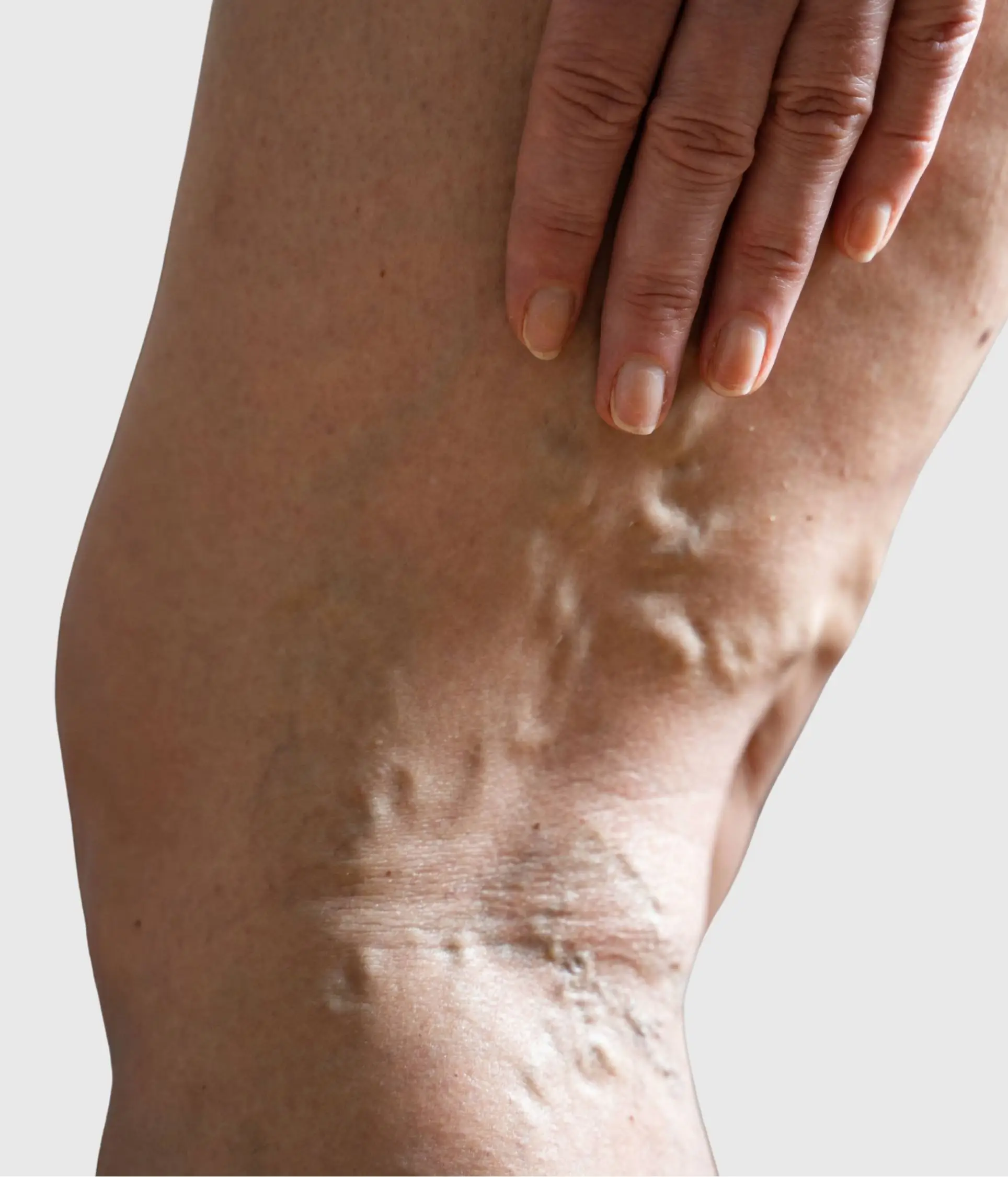 Varicose Veins treatment