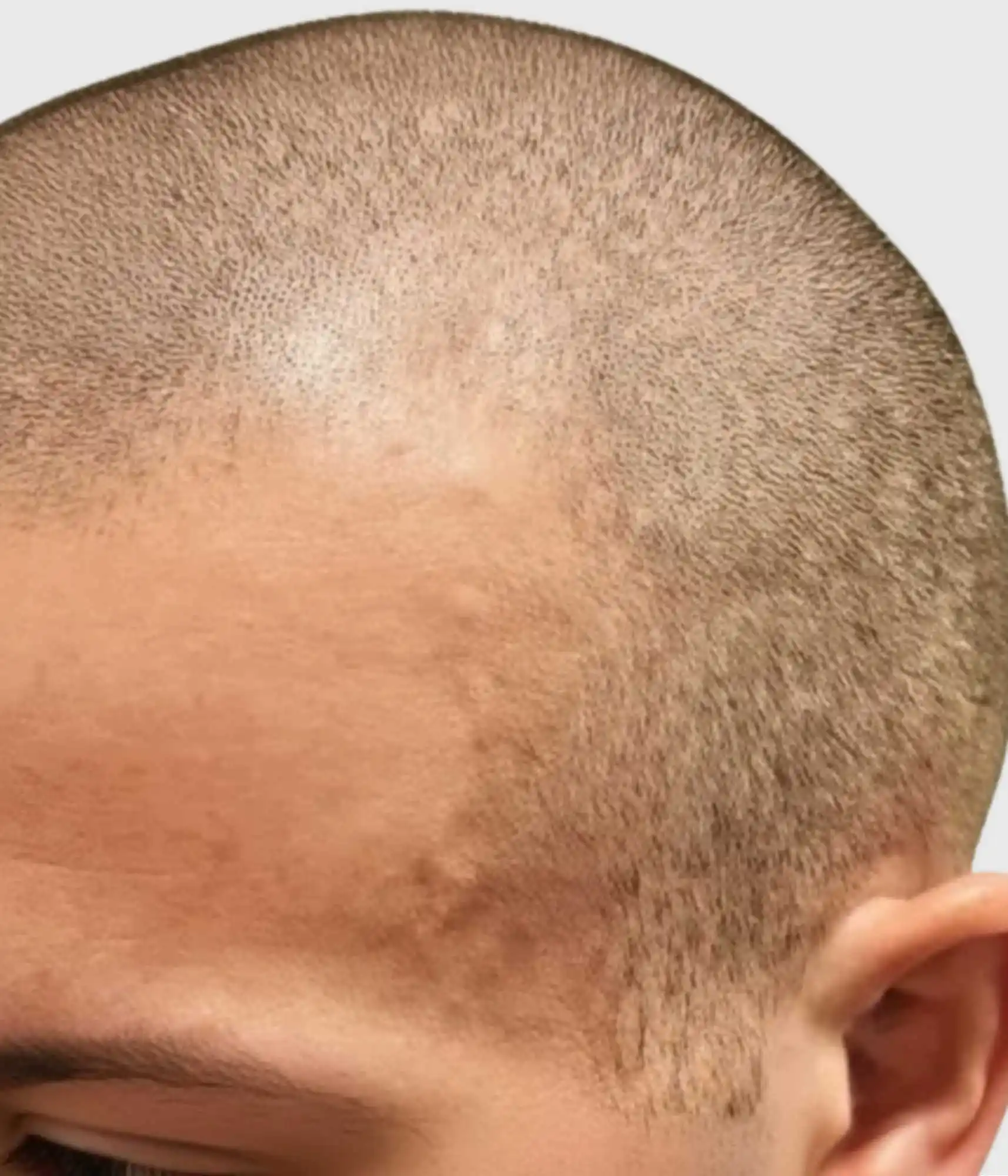 Superficial temporal arteries (temple arteries)