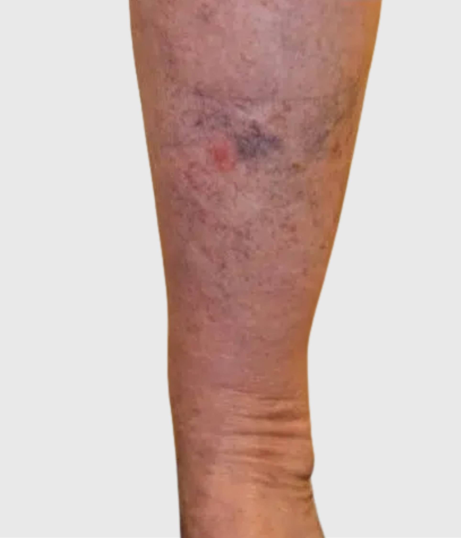 Venous Eczema