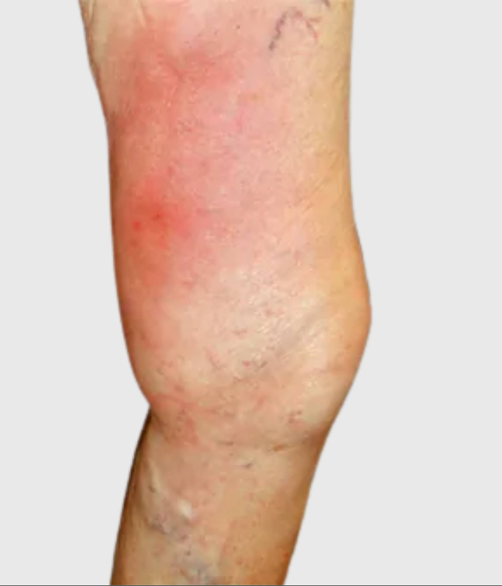 phlebitis