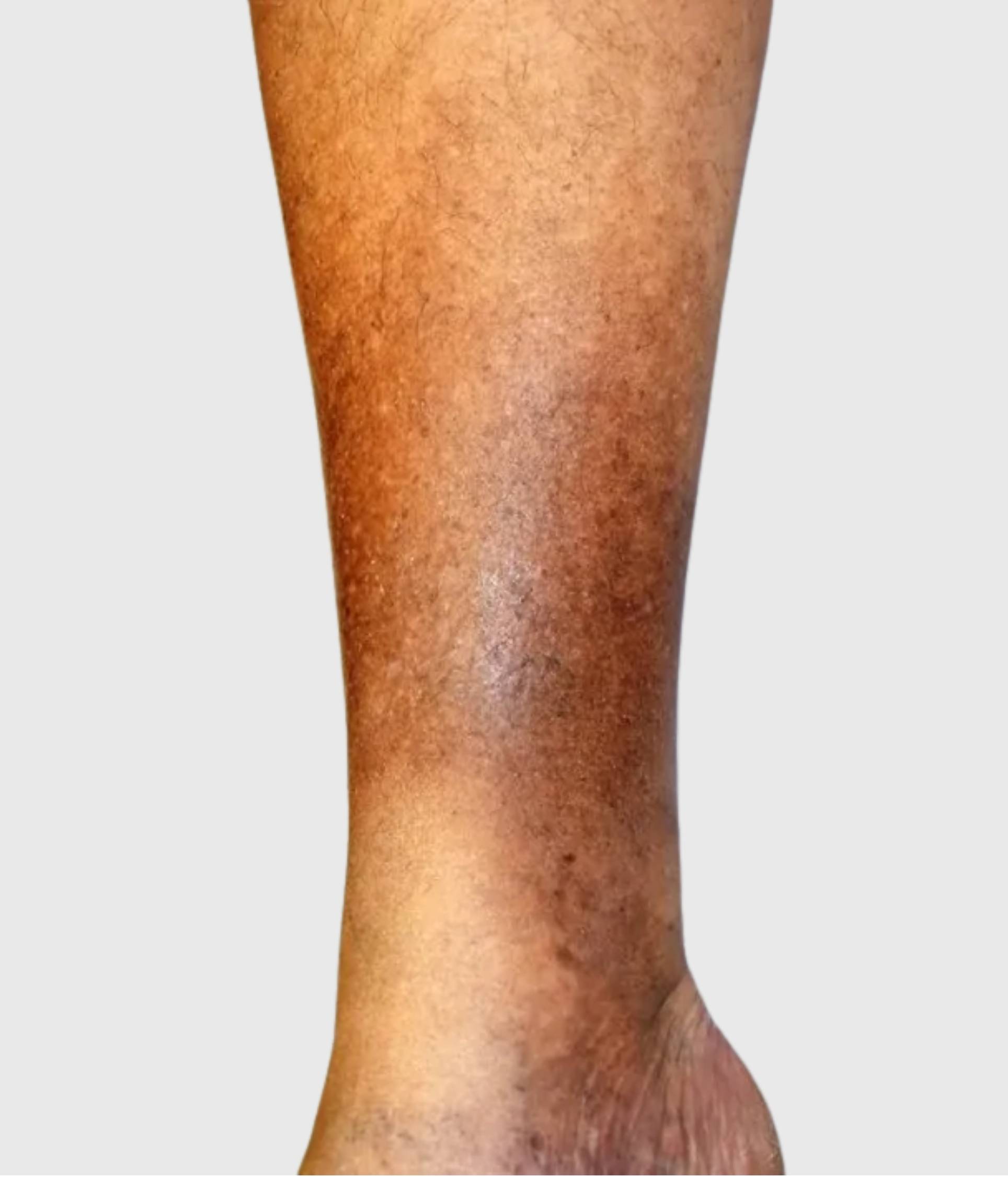 Haemosiderin - Brown Stains