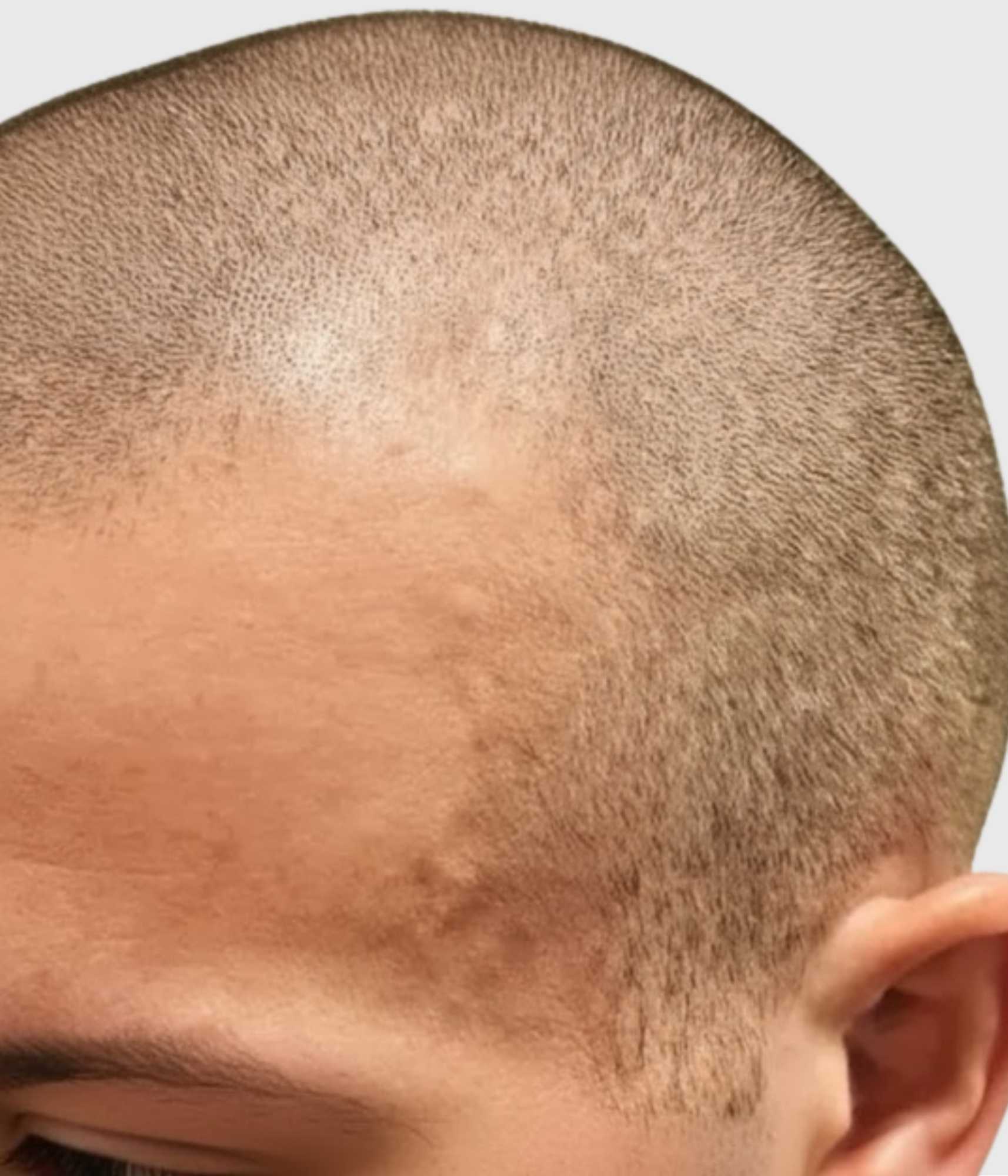 Superficial temporal arteries (temple arteries)