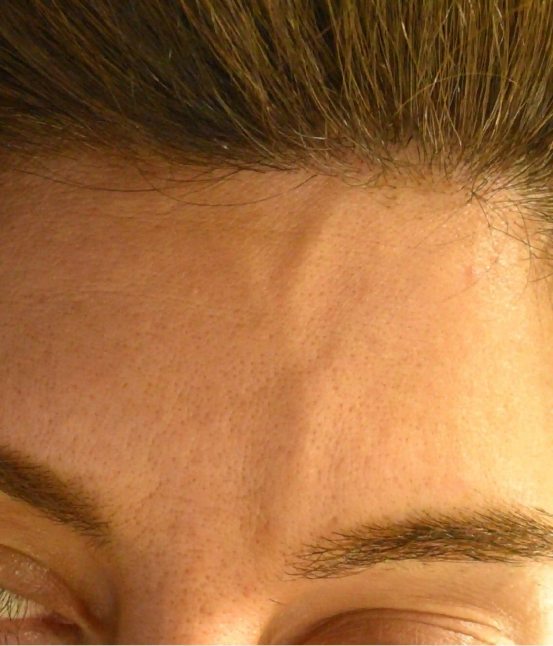 Forehead Veins