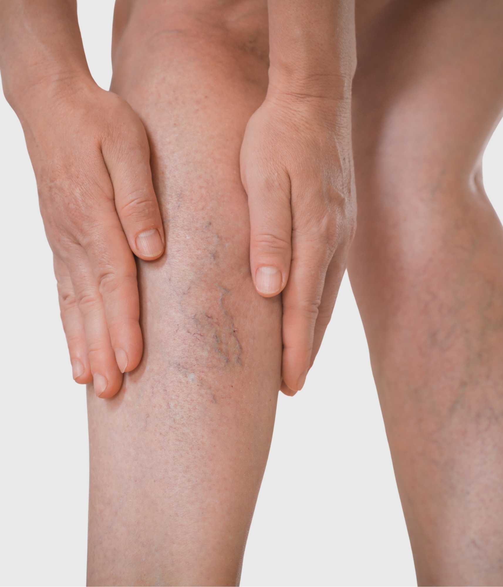 Thread Veins (Spider Veins)