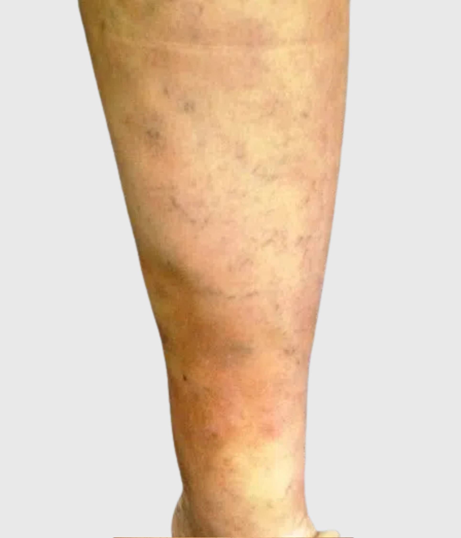 Lipodermatosclerosis (LDS)