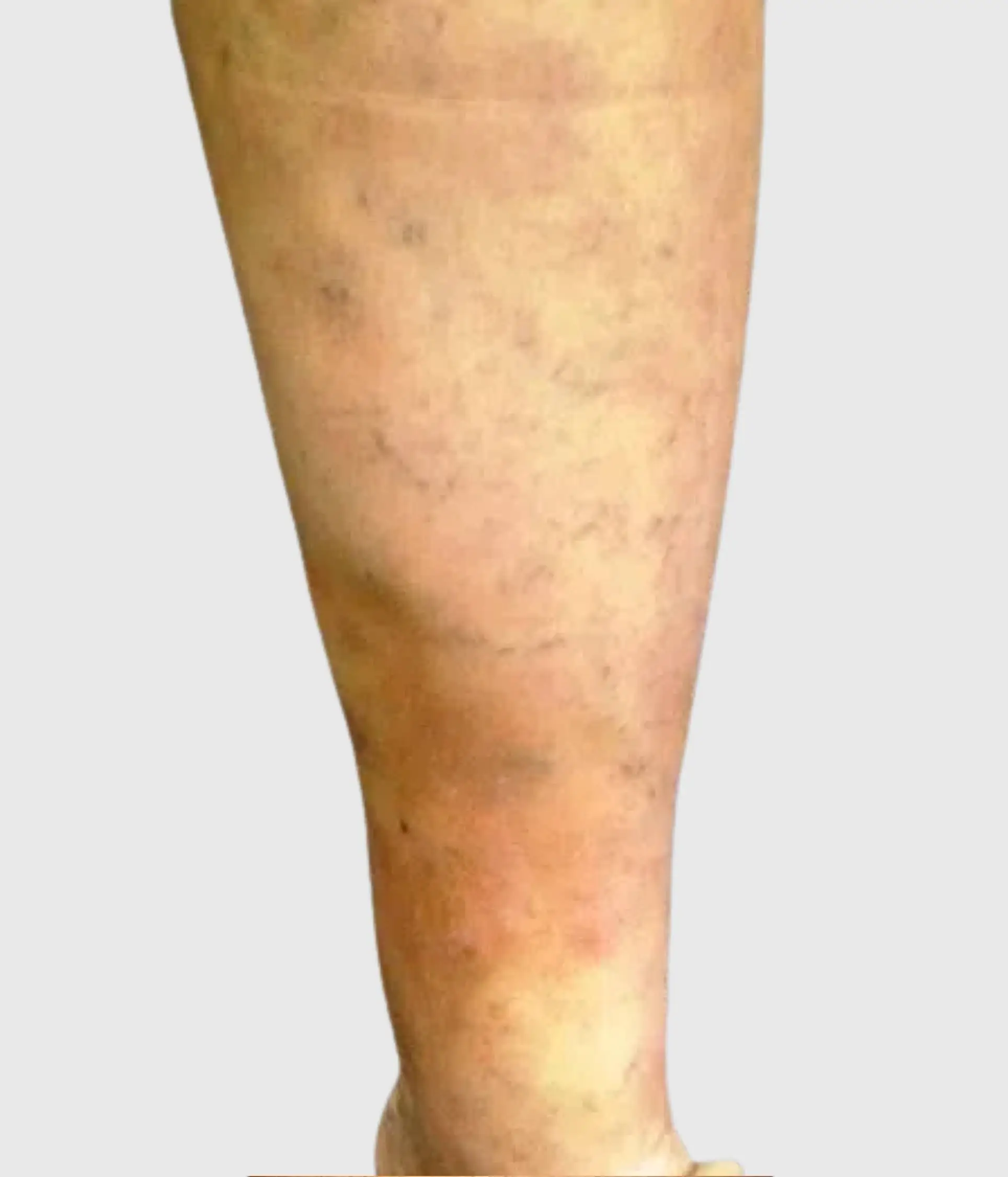 Lipodermatosclerosis (LDS)