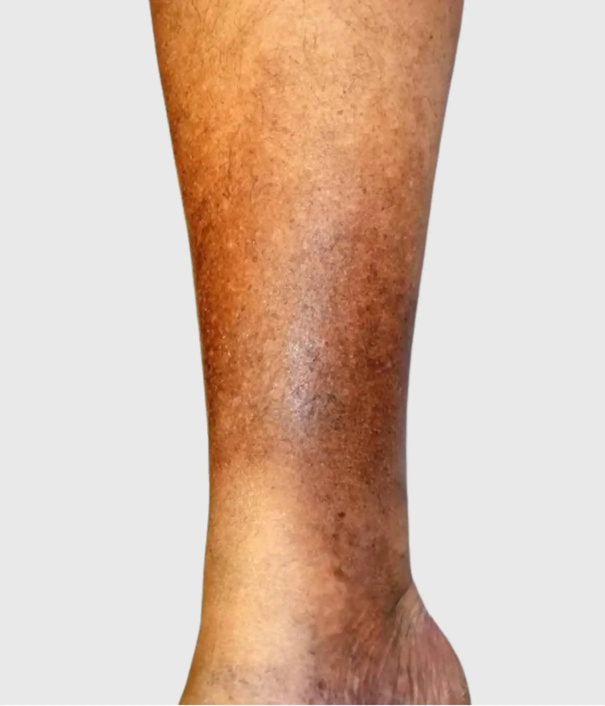 Haemosiderin - Brown Stains