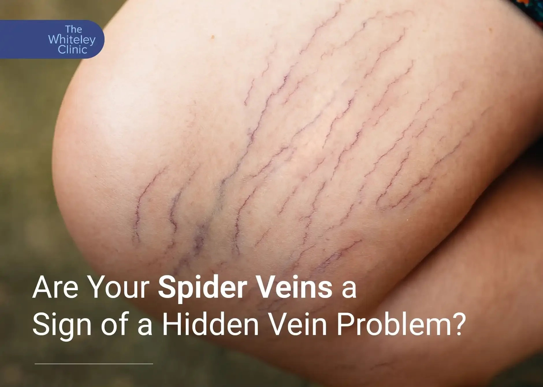 Symptoms of spider Veins