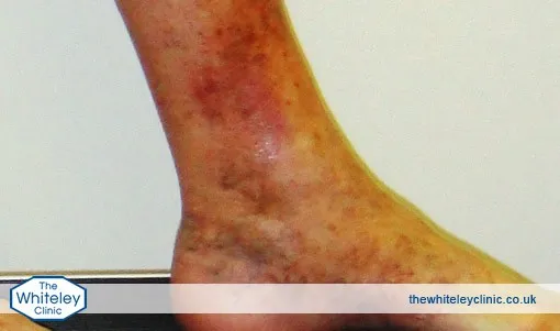 An ankle displaying haemosiderin
