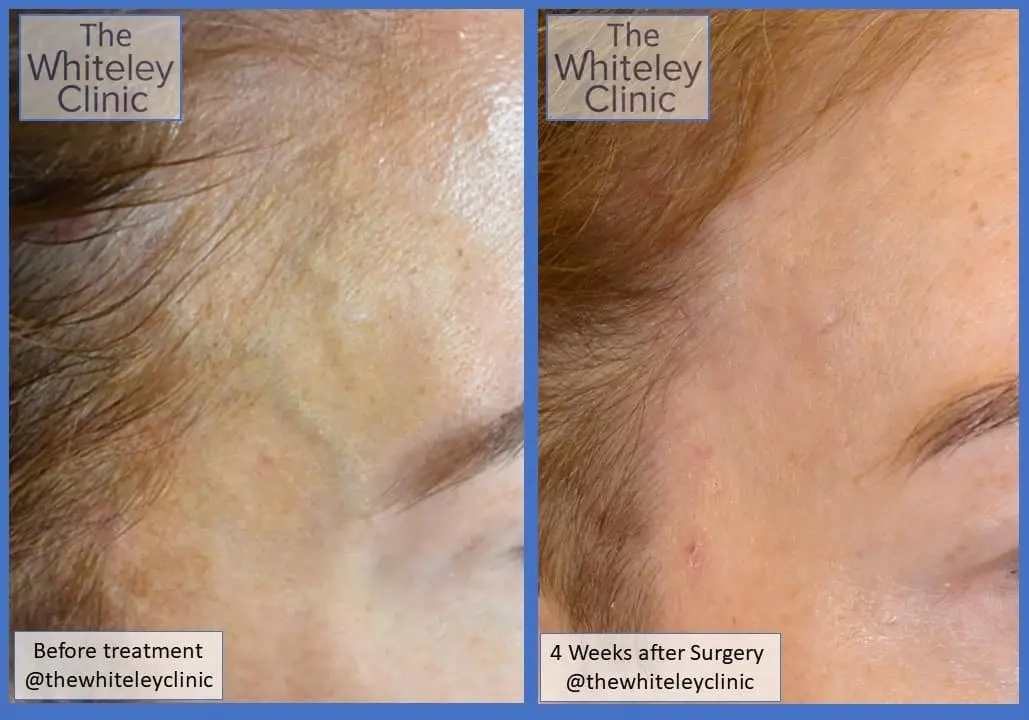 before and after removing a temple vein