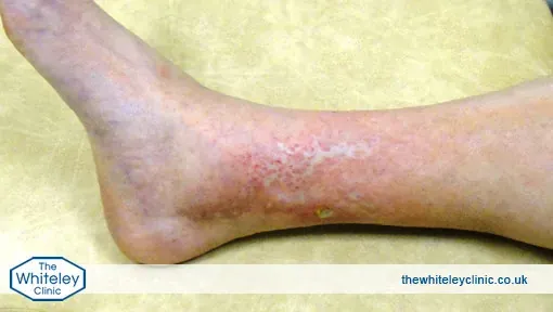 symptoms of Phlebitis
