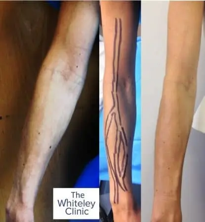 Right arm veins removal at The Whiteley Clinic