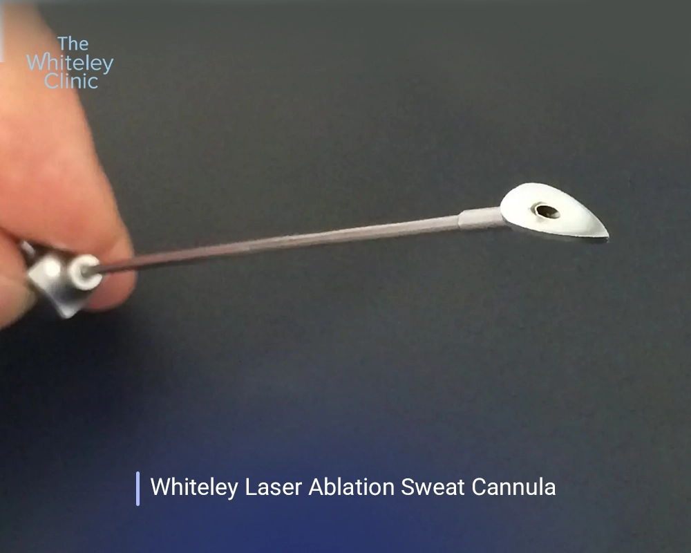Whitely Laser Ablation Sweat Cannula