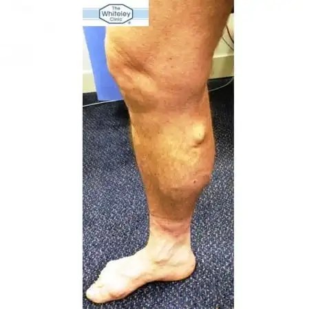 Varicose Veins - Simple Test by The Whiteley Clinic