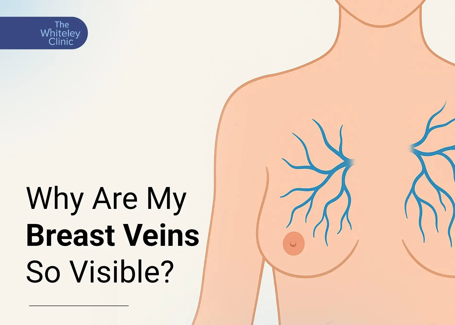 Why Are My Breast Veins<br />So Visible?