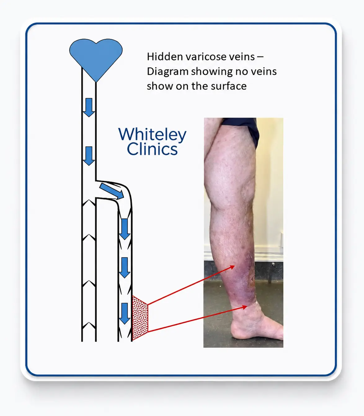 Hidden varicose veins diagram showing venous reflux causing leg ulcer despite no visible surface varicose veins