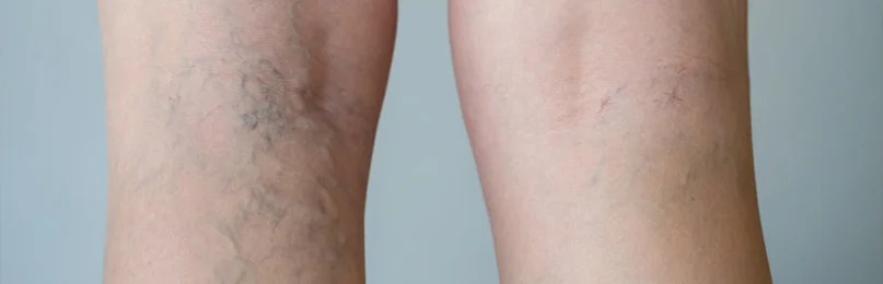 varicose veins in the Express