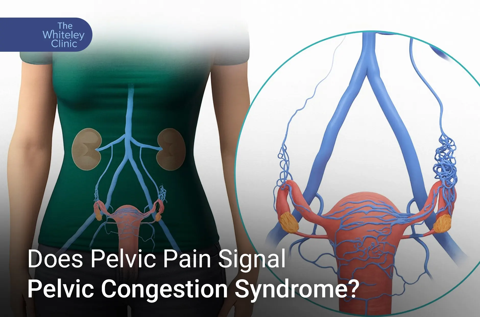 Does Pelvic Pain Signal Pelvic Congestion Syndrome?