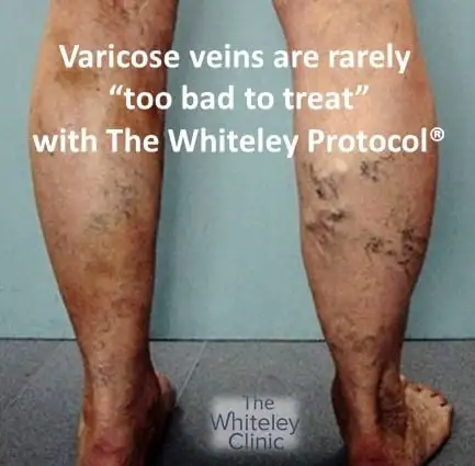 Varicose veins are rarely