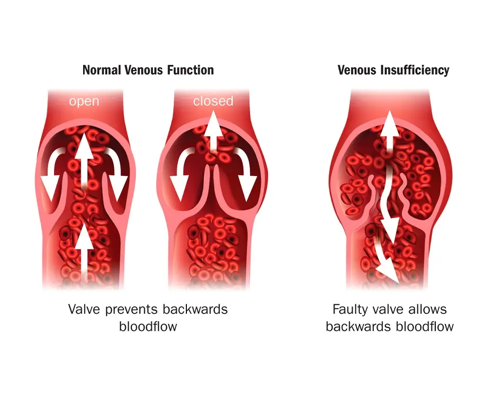 Haemorrhoids Might Signal Pelvic Venous Reflux