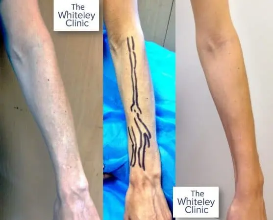 left arm veins removal at whiteley clinic