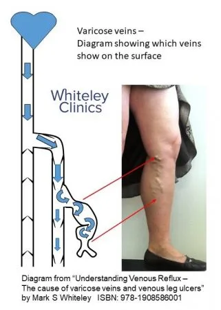 Varicose veins - diagram showing which bulging veins are visible on surface on standing in patient with varicose veins - The Whiteley Clinic