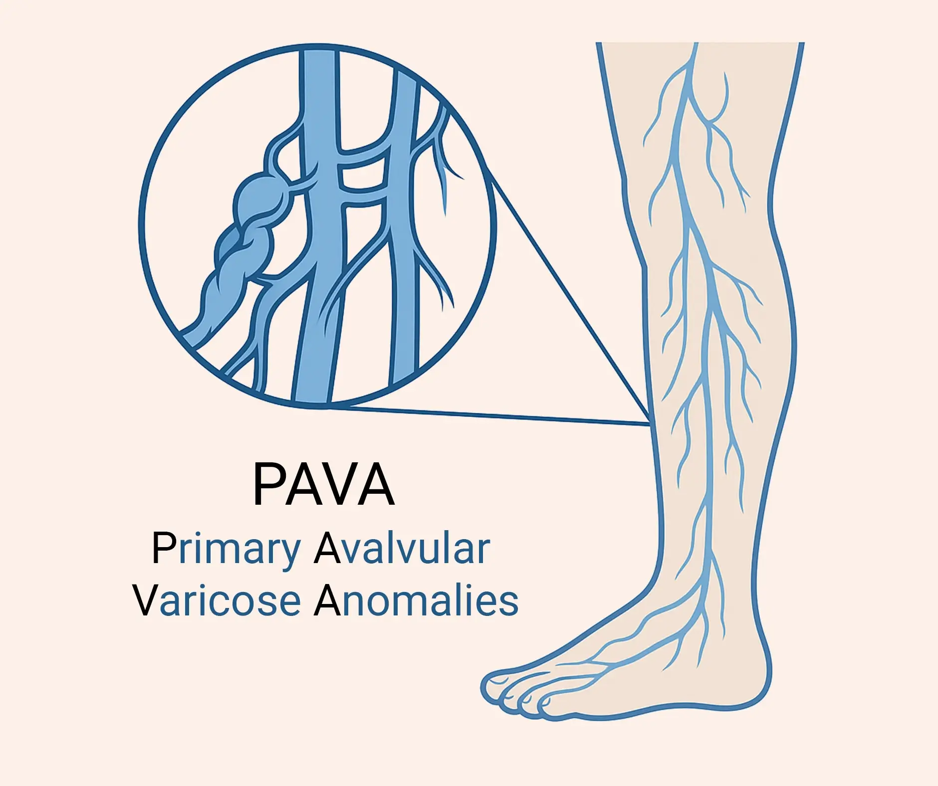 Primary Avalvular Varicose Anomalies (PAVA)