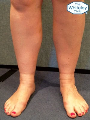 Swollen ankle with varicose veins and stock imprints - CEAP C3