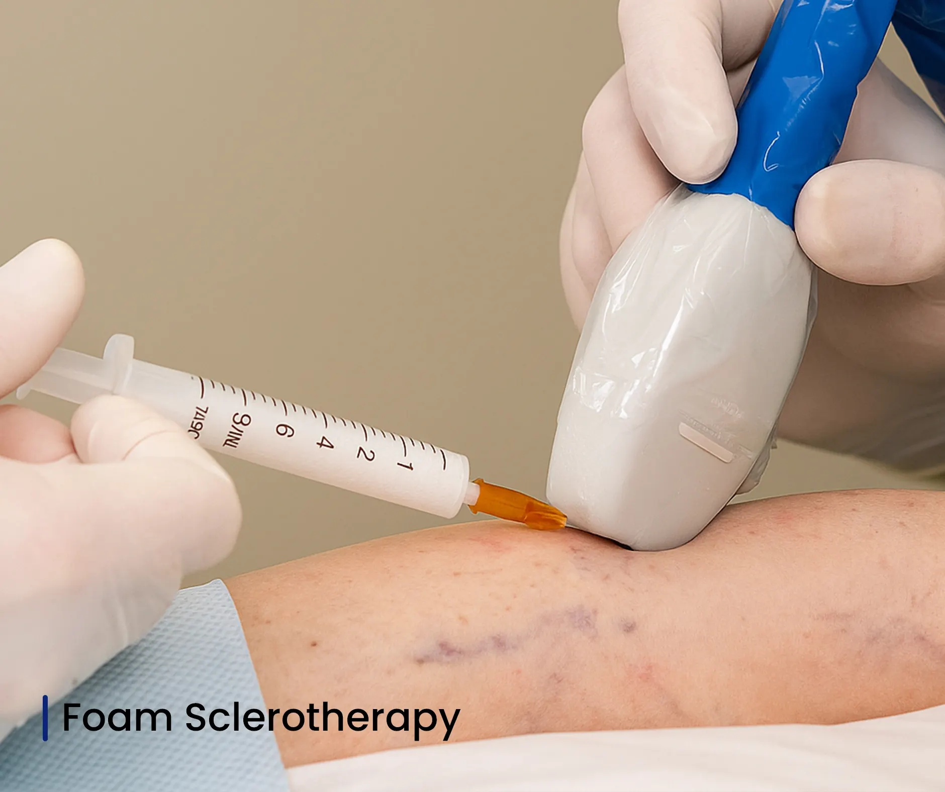Foam Sclerotherapy