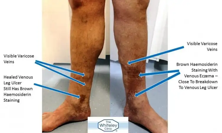 Patient with Healed Leg Ulcer Right and Venous Eczema Left - Curable By The Whiteley Protocol&reg; - The Whiteley Clinic