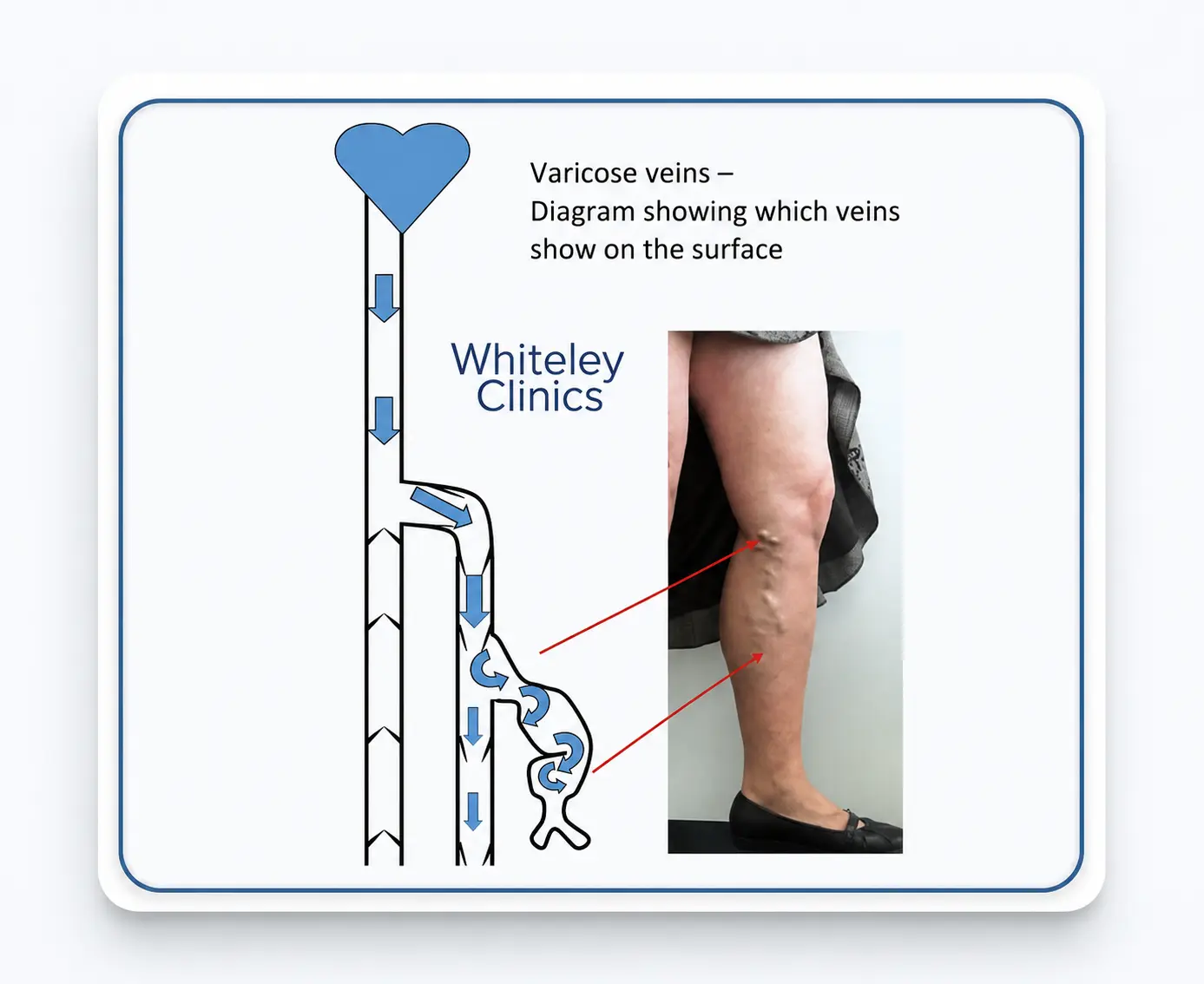 Diagram showing which veins show on the surface