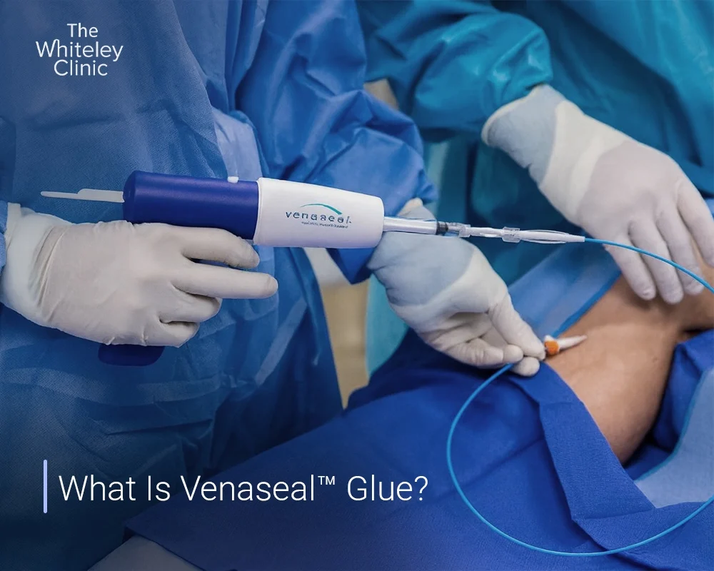 What Is Venaseal Glue?