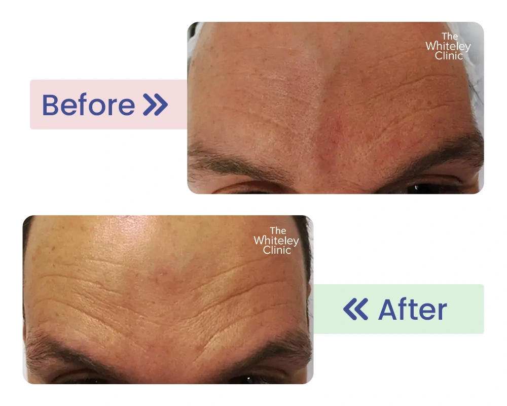 Before and after photos of forehead veins following minimally invasive treatment.