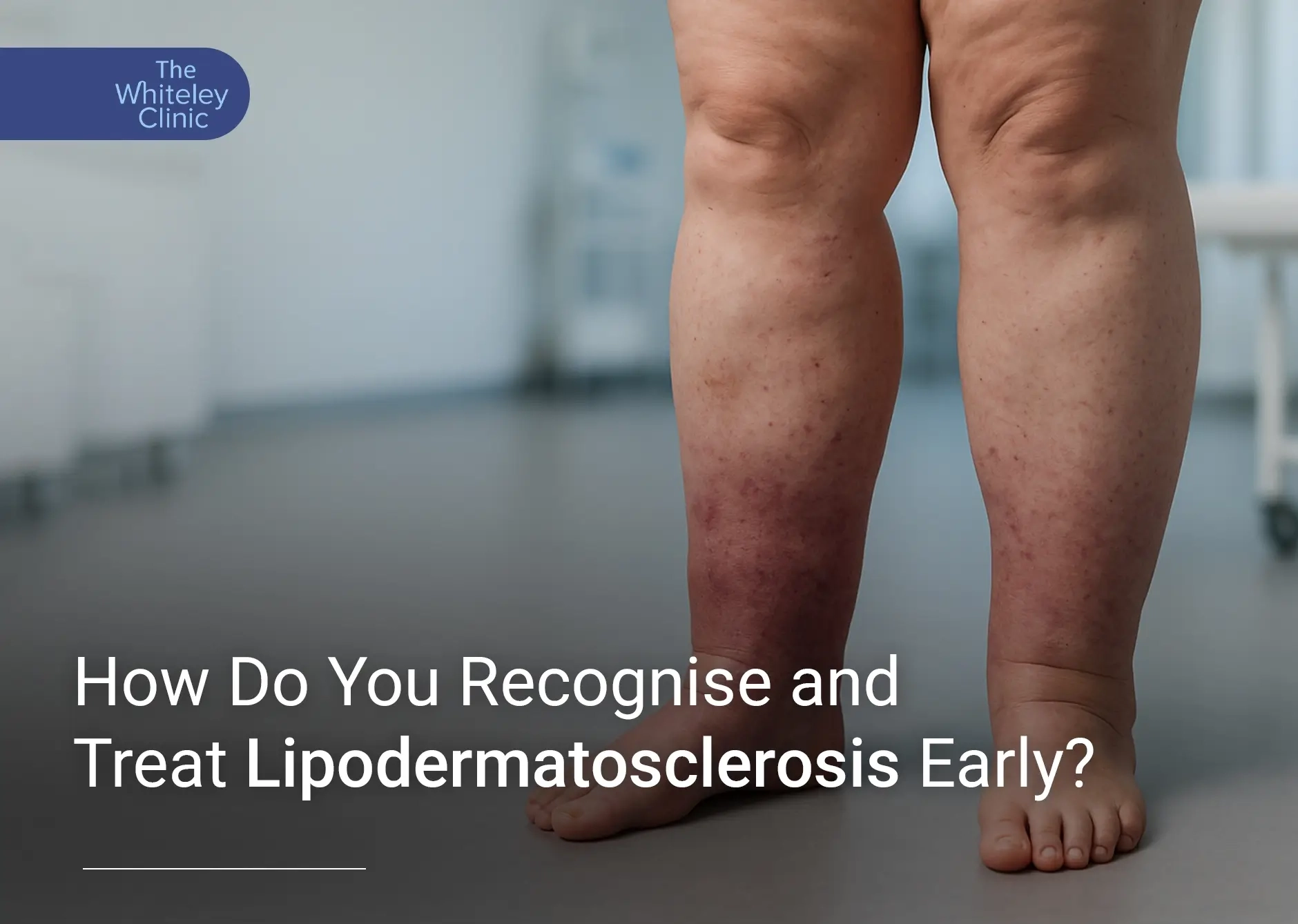 What is Lipodermatosclerosis?
