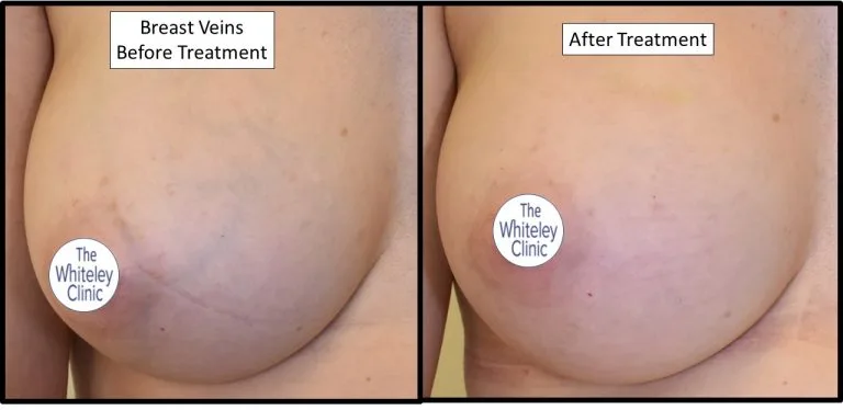 Removal of breast veins before and after at The Whiteley Clinic – Pioneering Vein Treatments