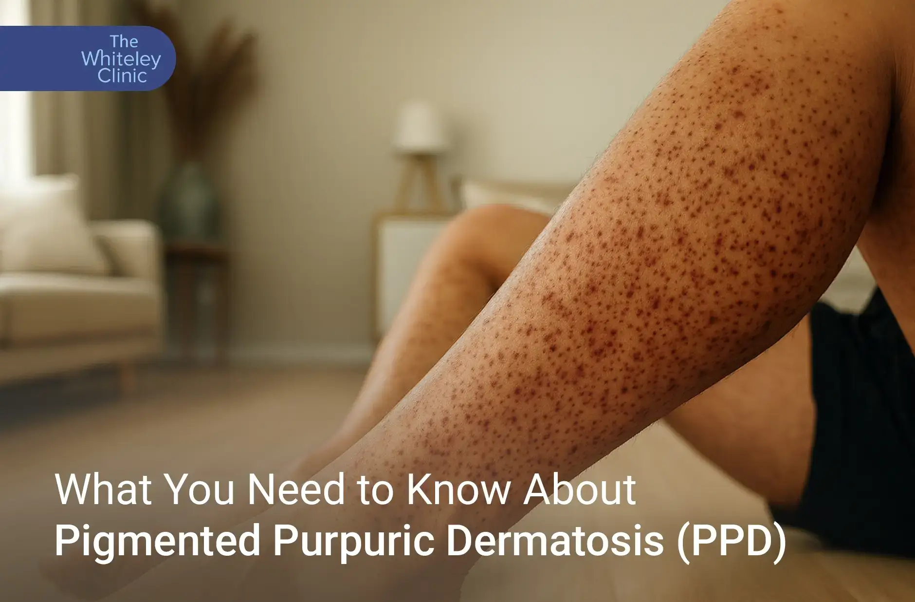 Pigmented Purpuric Dermatosis (PPD)
