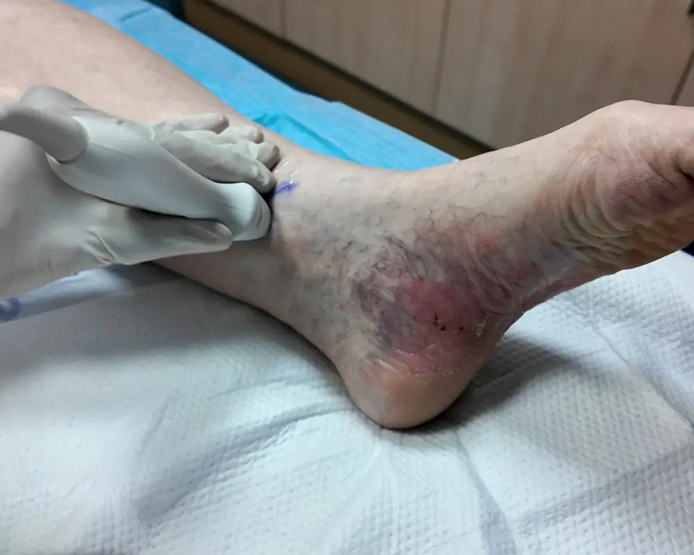 Vein treatment necessity