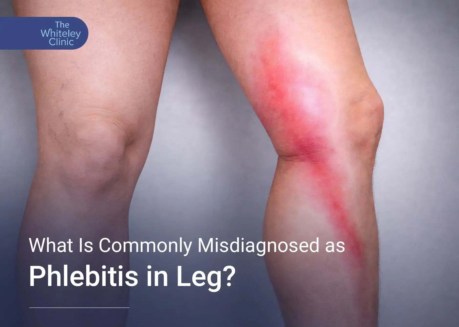 What Is Commonly Misdiagnosed asPhlebitis in Leg?