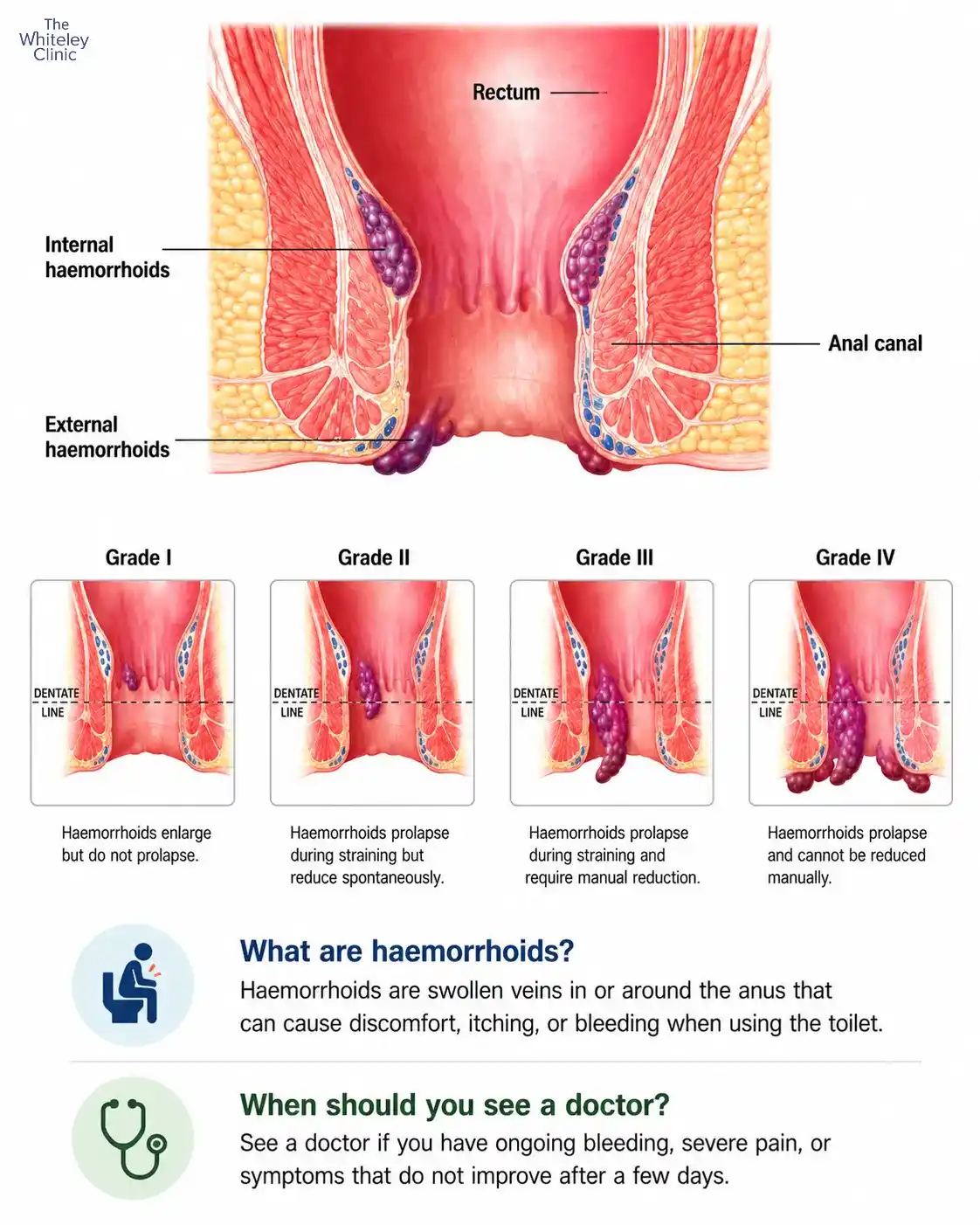 Types of haemorrhoids