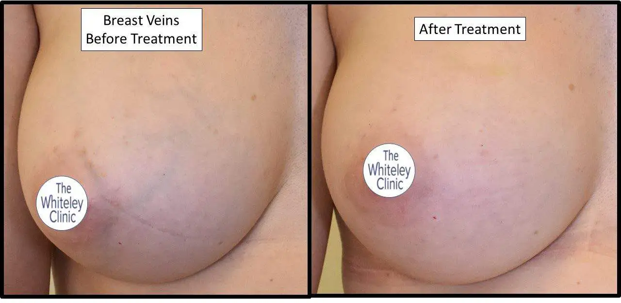 before and after Breast Veins<br />Treatment
