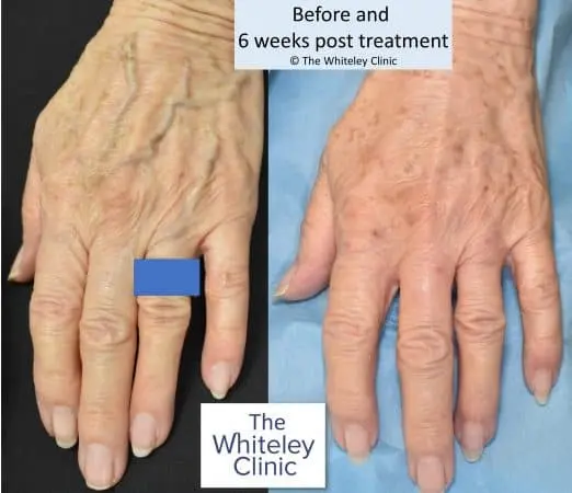 before and 6 week after hand vein treatment