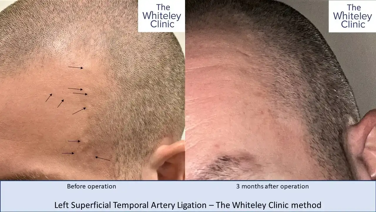 Left Superficial Temporal Artery Ligation - The Whitely Clinic method