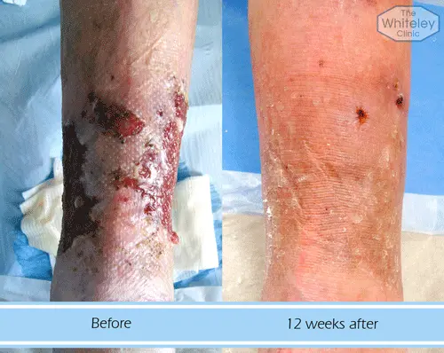 A venous leg ulcer patient - 12 weeks post treatment