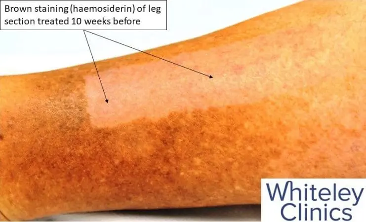 Brown staining (haemosiderin) of leg section treated 10 weeks before